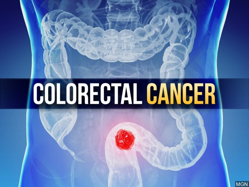 Colon Cancer_MGN image