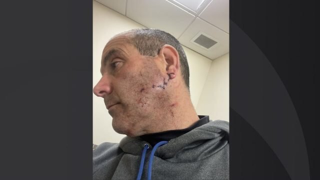 <i>Stoneham Police/WBZ</i><br/>Stoneham police officer Joe Ponzo shows the stiches he received after being mauled by a dog on January 16.