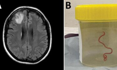 The worm specimen was extracted alive from the woman's brain by surgeons at Canberra Hospital in Australia.