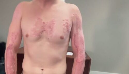A man who suffered third-degree burns across much of his body after Phoenix officers pinned him face down on the scorching hot pavement has filed a federal lawsuit against the city.