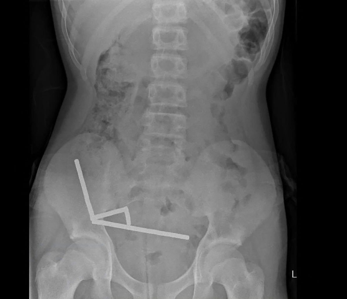 <i>New Zealand Medical Journal/AFP/Getty Images via CNN Newsource</i><br/>This undated handout released on Friday from the New Zealand Medical Journal (NZMJ) shows an x-ray image of pieces of high-power magnets clumped up in the intestines of a New Zealand teenager in Tauranga.